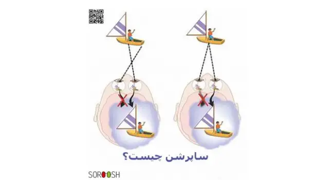 ساپرشن چیست