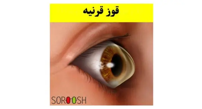 قوز قرنیه